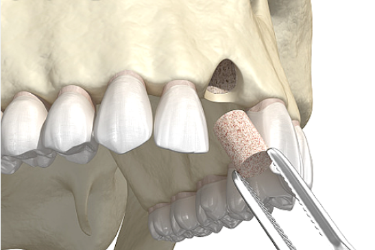 뼈이식 임플란트 시술 과정 비용 통증 관리 후기