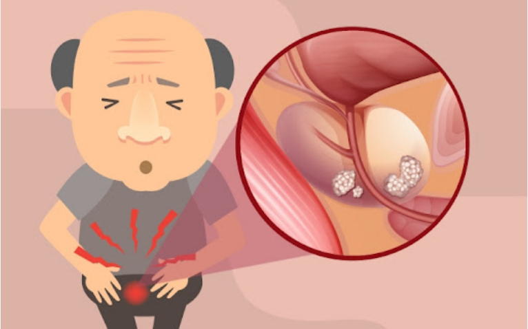 전립선암 증상 원인 염증 예방법 검진주기