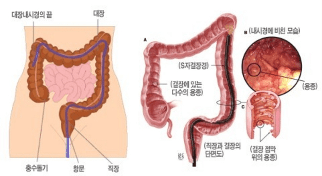 대장내시경으로 대장 내부를 관찰하는 검사 장면